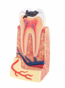 Tooth Decay