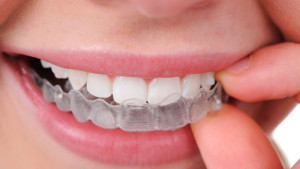 Invisalign
