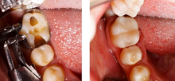 Cavity Dental Filling, Tooth Cavity