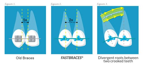 FastBraces