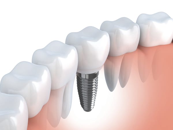 Implant Therapy